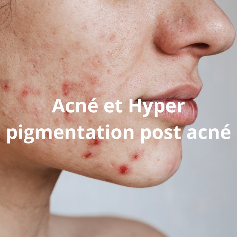 JE VOUS EXPLIQUE COMMENT PRENDRE EN CHARGE L'ACNE