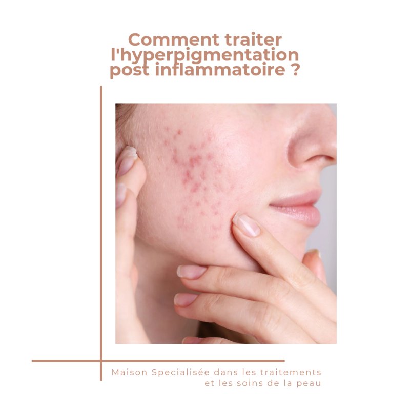 Quel traitement pour l'hyperpigmentation inflammatoire?