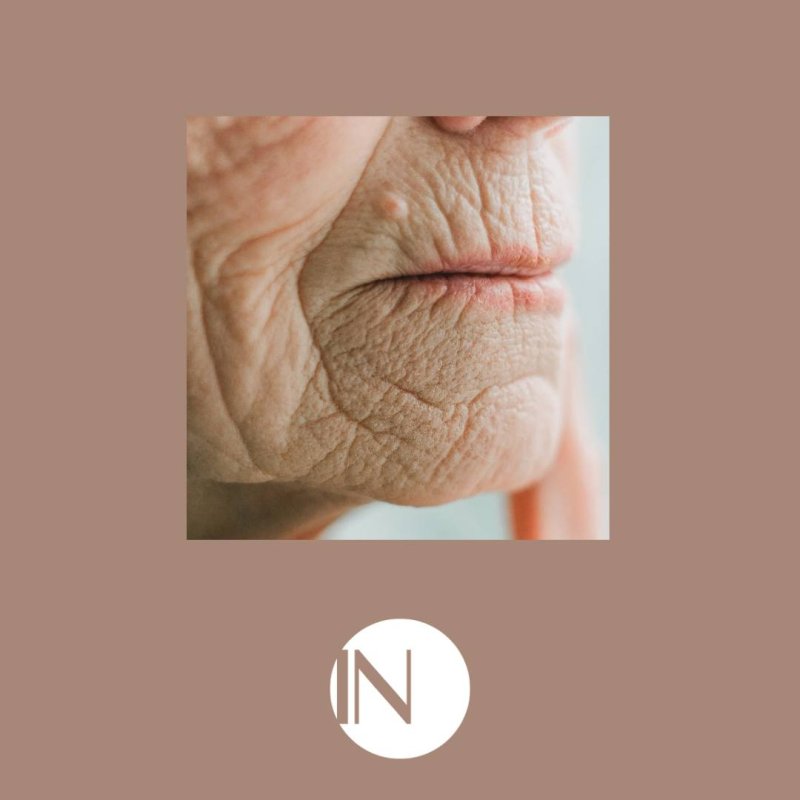 Pr&eacute;servez l'&Eacute;lasticit&eacute; de Votre Peau : Comprendre l'&Eacute;lastose Solaire et Agir !